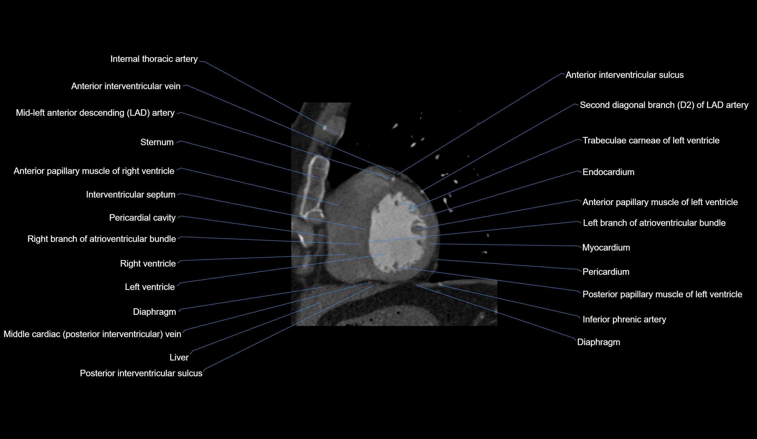 CT heart (coronary angiogram) short axis view  cross sectional anatomy labelled radiology image-00038.webp